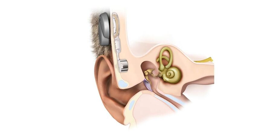 Foi aprovada pelo Ministério da Saúde (MS) a cirurgia do Bonebridge, o primeiro implante de condução óssea ativo do mundo desenvolvido pela austríaca Med-El