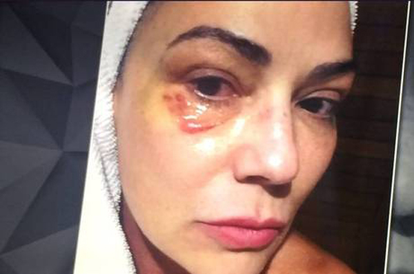 Luiza Brunet mostra olho machucado após agressão