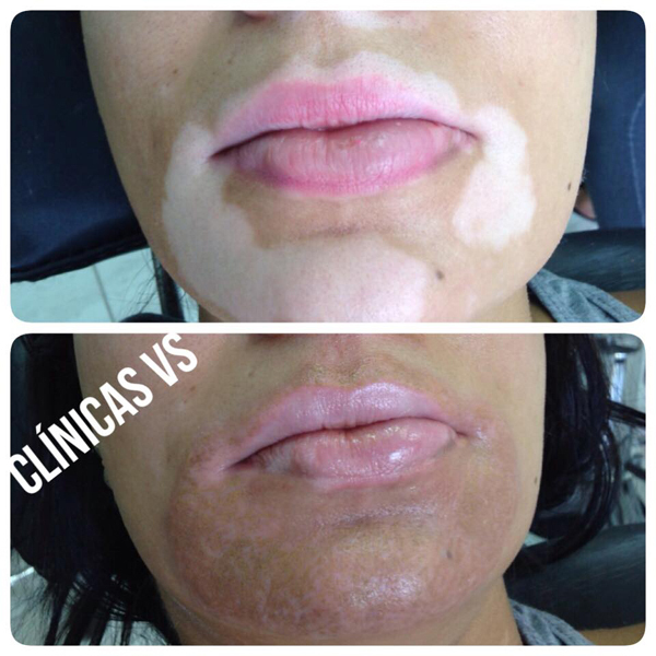 A micropigmentação, procedimento que deposita pigmentos no tom mais próximo à pele do paciente, é a mais nova aliada para quem sofre com o vitiligo