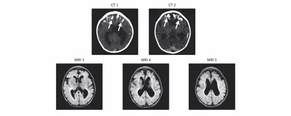 Nas imagens da tomografia na parte superior da figura, as setas brancas indicam as lesões no cérebro de bebê que permaneceu com o Zika ativo no organismo por 67 dias; abaixo, ressonância magnética mostra redução de volume das regiões frontal e parietal