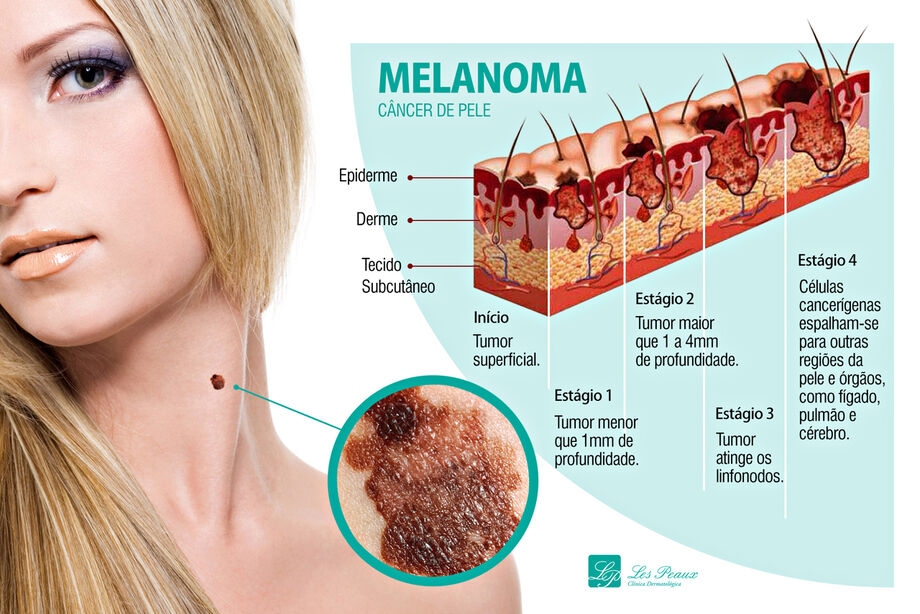 O câncer de pele melanoma é o mais agressivo. São geralmente os casos que iniciam com o aparecimento de pintas escuras na pele, que apresentam modificações ao longo do tempo