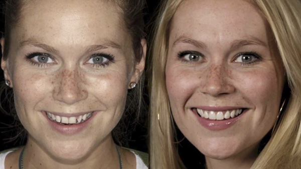 Antes e depois de uma paciente após a aplicação das lentes de contato para os dentes