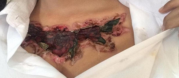 Foto da Tailandesa que colocou ácido para remover a sua tatuagem