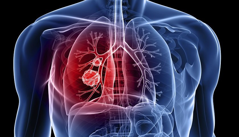 A infecção dupla por tuberculose e HIV aumenta em mais de 200% a chance de óbito quando comparado a pessoas com tuberculose e sem HIV