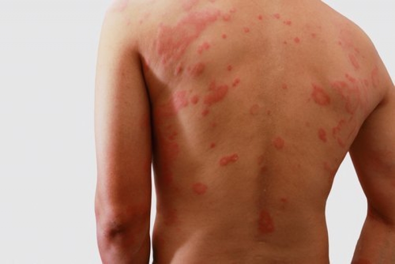 Quando tratada adequadamente e o quanto antes, é possível que o paciente infectado fique completamente curado. O diagnóstico e tratamento tardio podem causar incapacidades físicas