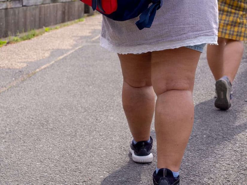Mais raro nos homens, o lipedema tem quadro caracterizado pelo depósito de gordura e inchaço localizado nas pernas e braços, com exclusão das mãos e pés, e dores nas áreas afetadas
