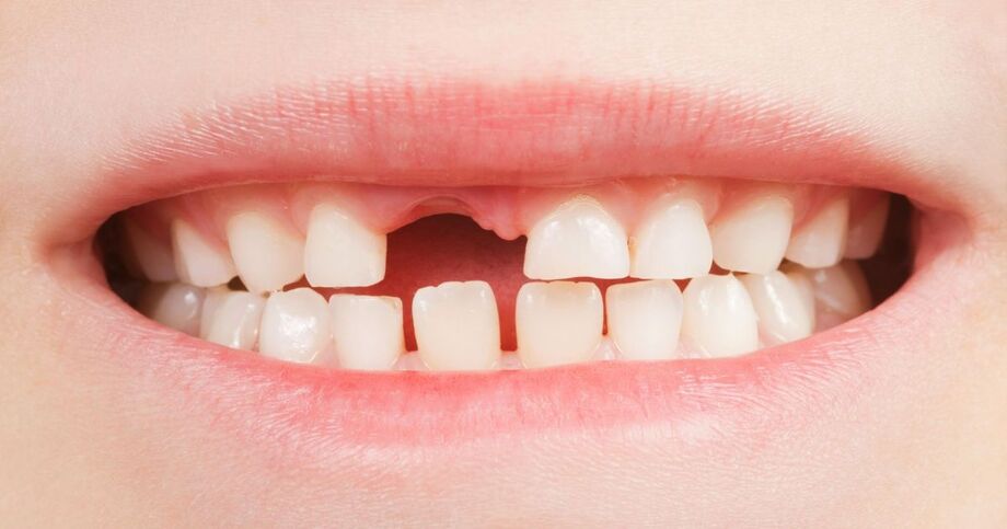 Com o choque, ele sofreu um corte, acompanhado de sangramento e amolecimento do dente dianteiro