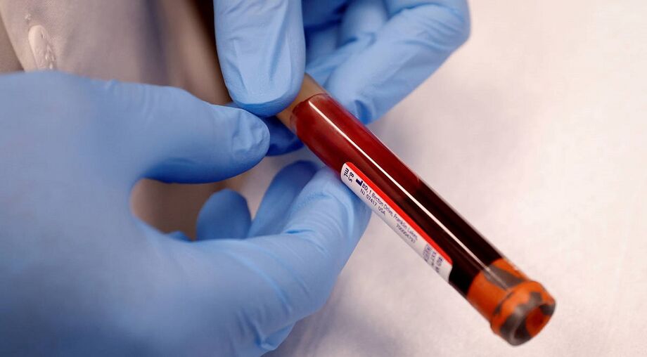 O teste sorológico pode ser realizado através de amostras de plasmas, sangue ou soro