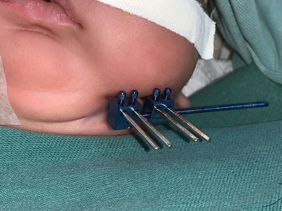 Ao todo, foram cerca de 2h30 de cirurgia sem intercorrências e dentro das expectativas da equipe que acompanhava o caso clínico desde sua admissão no hospital