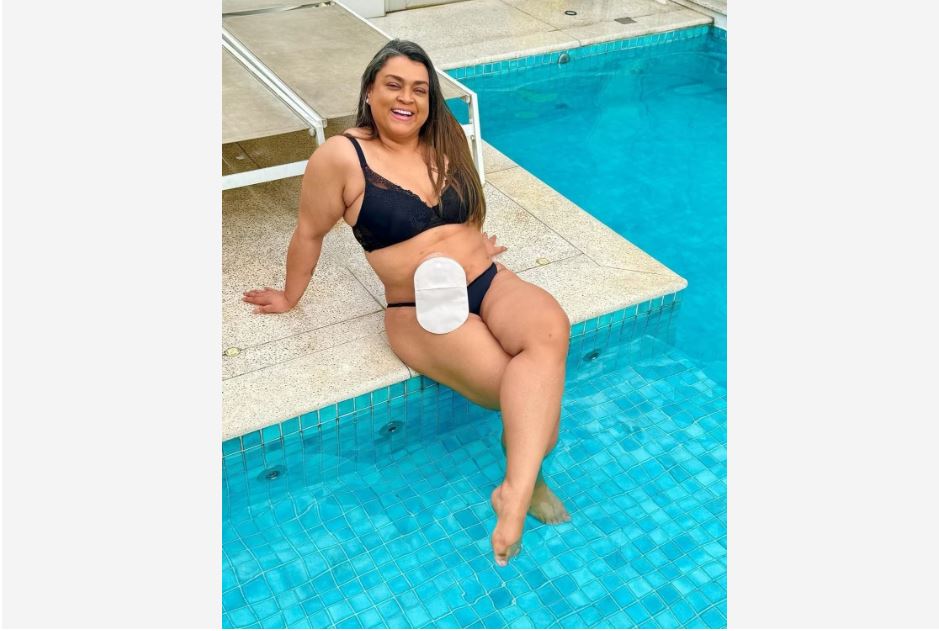 Preta Gil mostra a bolsa de ileostomia