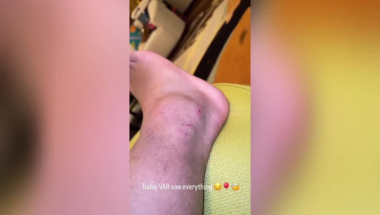 Tornozelo de Memphis ficou incahdo após o pisão