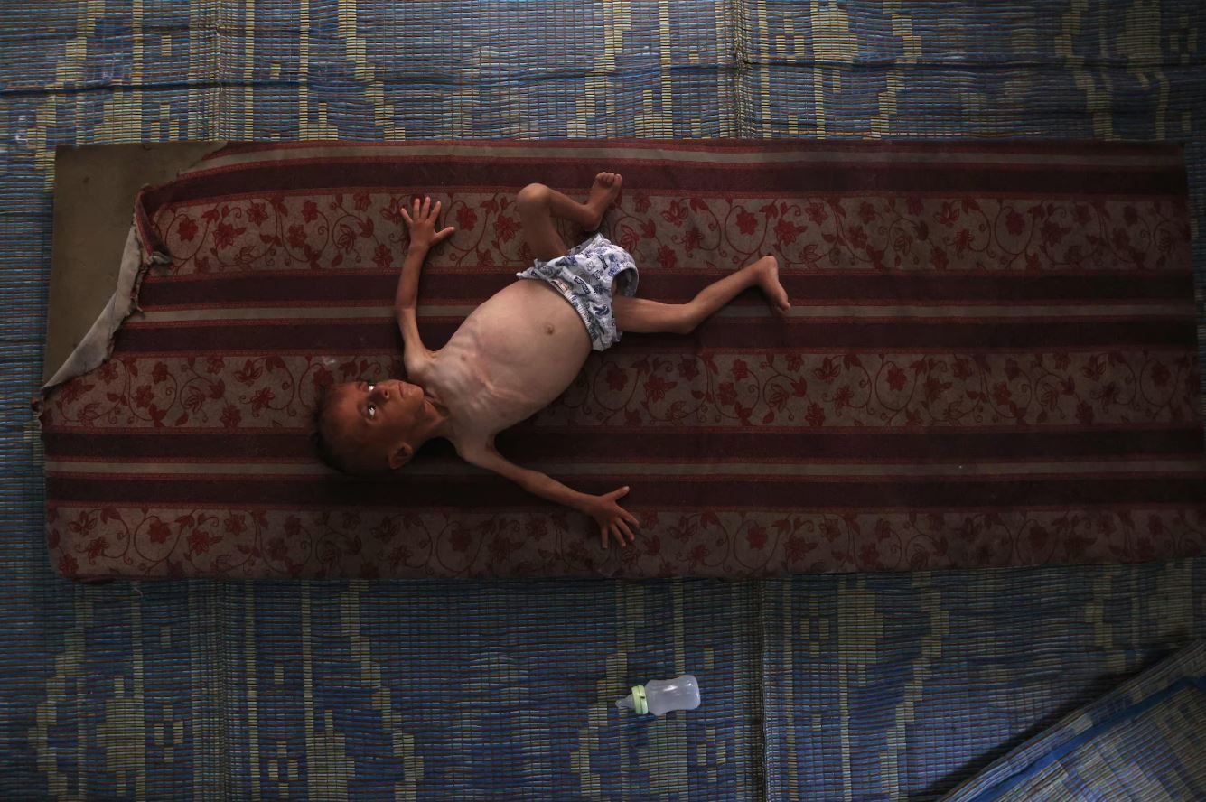 Imagem mostra Mohammed al-Mutawaq, um bebê palestino de 1 ano e 6 meses. Garoto está doente e está subnutrido, enquanto entrega de ajuda humanitária é marcada por controle de Israel e violência