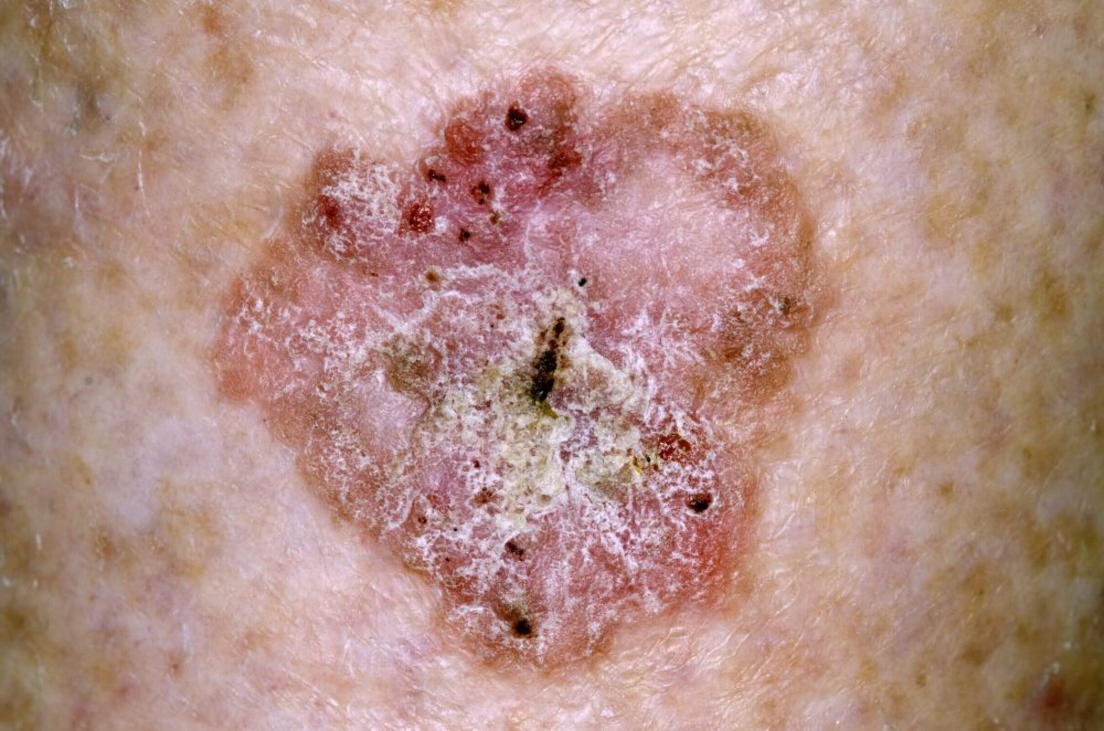 Carcinoma de células escamosas costuma se apresentar como lesão avermelhada com descamação e crosta.